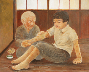 「吹き出物の治療」